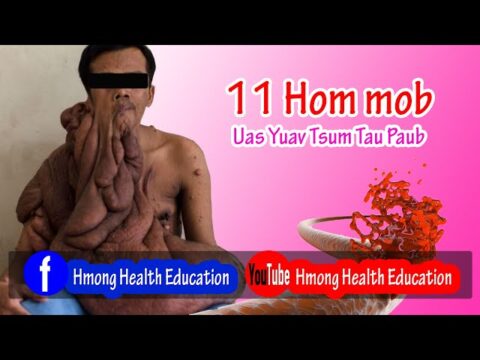 Hmong Health Education 11 Hom Kab Mob Yuav Tsum Tau paub EP: 05