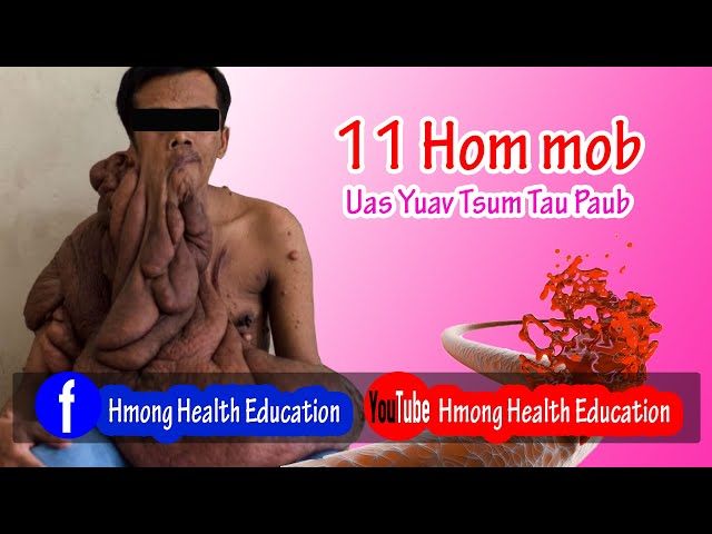 Hmong Health Education 11 Hom Kab Mob Yuav Tsum Tau paub EP: 05